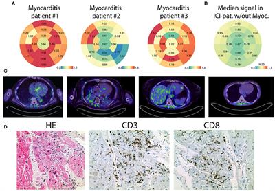 Early Detection of Checkpoint Inhibitor-Associated Myocarditis Using 68Ga-FAPI PET/CT